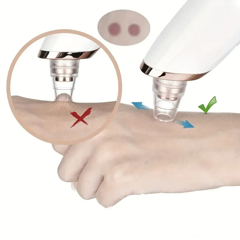 Blackhead Removal Suction Tool – Electric
